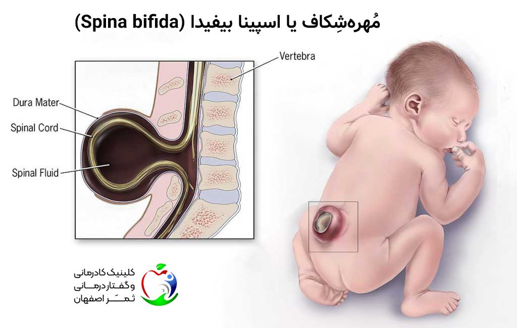مُهره‌شِکاف یا اسپینا بیفیدا (Spina-bifida)
